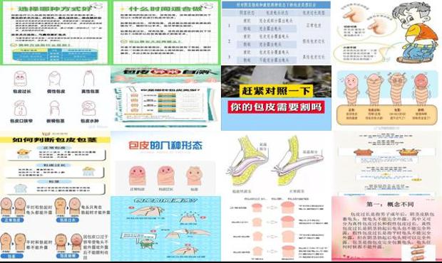 汕头假性包皮要不要割