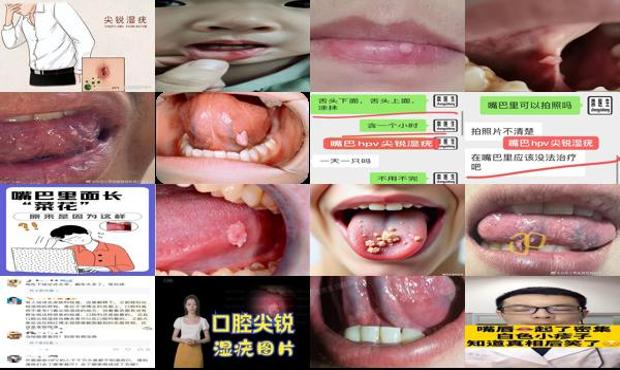 汕头嘴巴尖锐湿疣